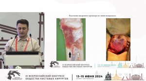 Мамедов Н.А.: модифицированный ладонный доступ к дистальному метаэпифизу лучевой кости.