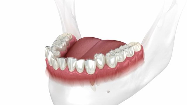 Элайнеры смотреть онлайн