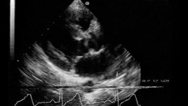 unicuspid aortic valve 2/2 with moderate stenosis and regurgitation