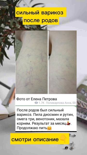 Варикоз