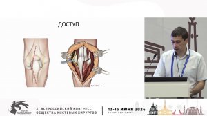 Ратьев А.П.: перелом проксимального конца локтевой кости (венечный и локтевой отростки).