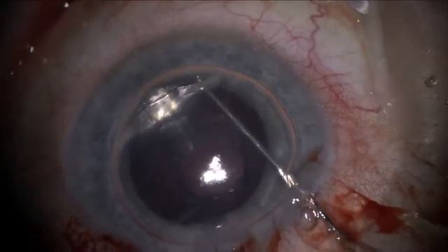 2019 Lamelläre Hornhauttransplantation - Descemet Membrane Endothelial Keratoplasty (DMEK) смотреть онлайн