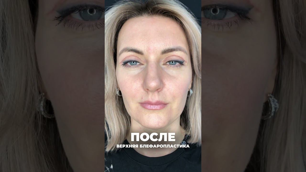 Регина. Блефаропластика. До и после