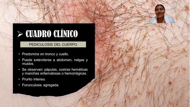 VIDEO DE PEDICULOSIS смотреть онлайн