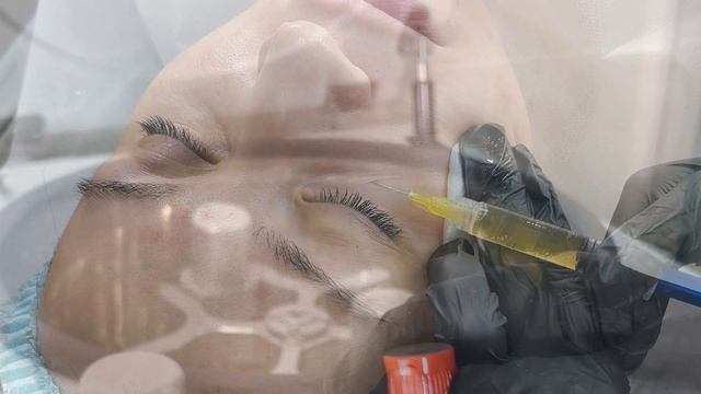 Плазмотерапия – восстановление и омоложение кожи с использованием собственных ресурсов организма