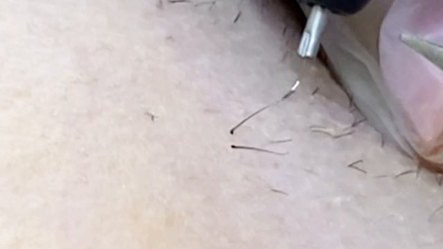 Электроэпиляция на подмышках