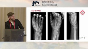 Миронов А.Р.: остеосинтез мостовидной пластиной в лечении закрытых переломов ДМЭ лучевой кости.