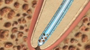 Discus dental - EndoVAC