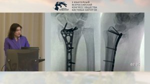Губайдуллина Г.Ф.: методики остеосинтеза оскольчатых внутрисуставных переломов ДМЭ лучевой кости.