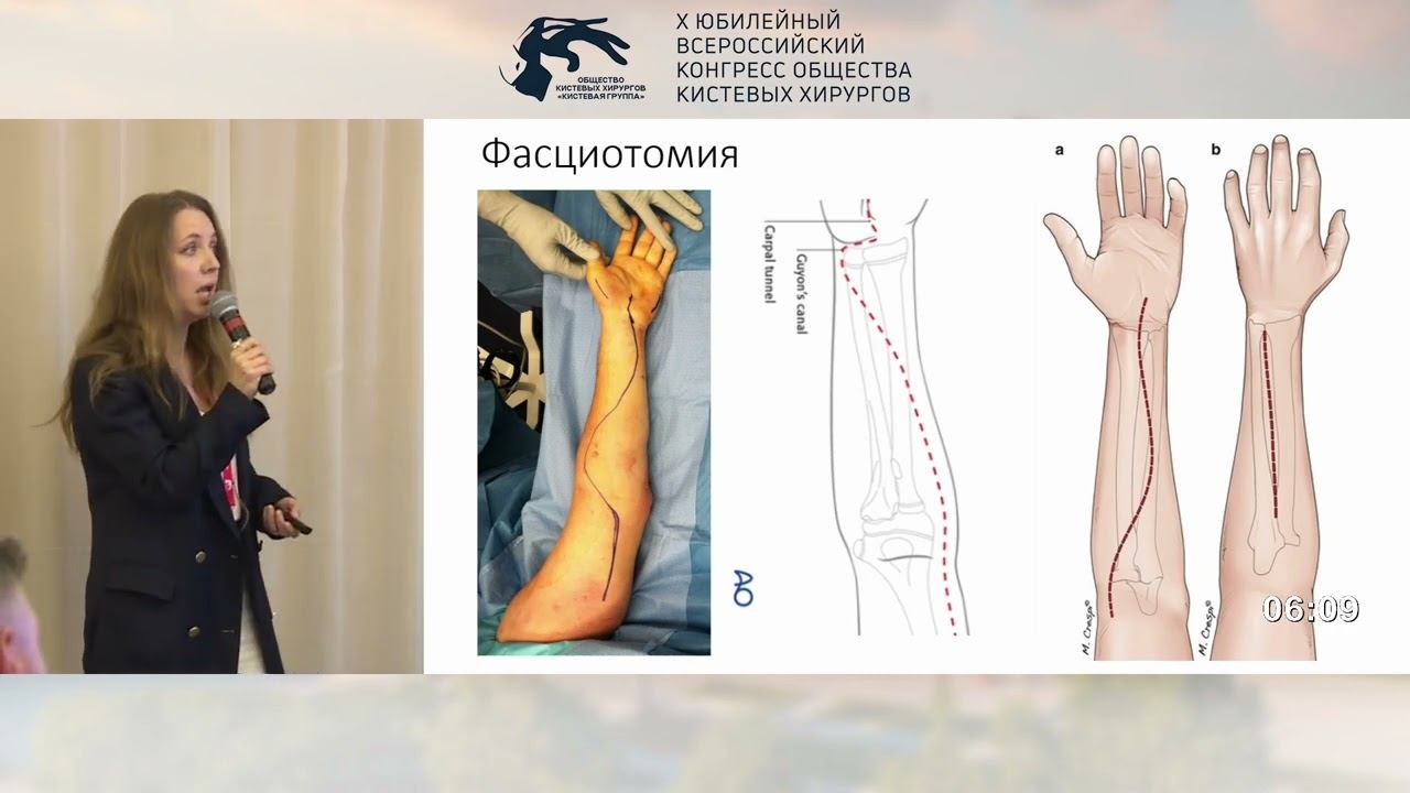 Титова А.Д.: острый и хронический компартмент синдром на кисти. Диагностика. Лечение.
