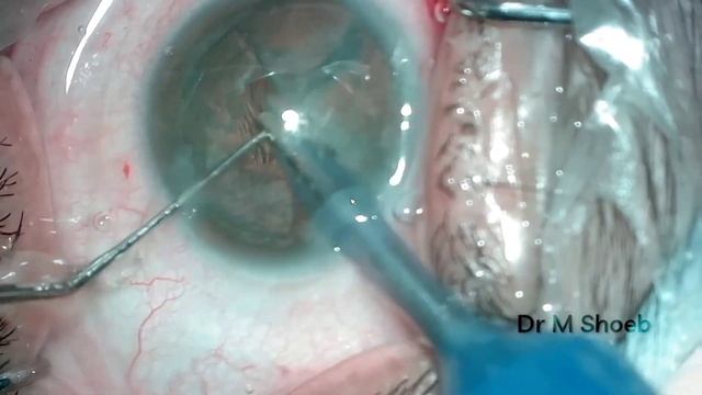 Vlog#20, Phaco in high myopia смотреть онлайн