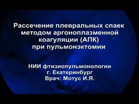 Рассечение плевральных спаек методом аргоноплазменнои коагуляции при пульмонэктомии
