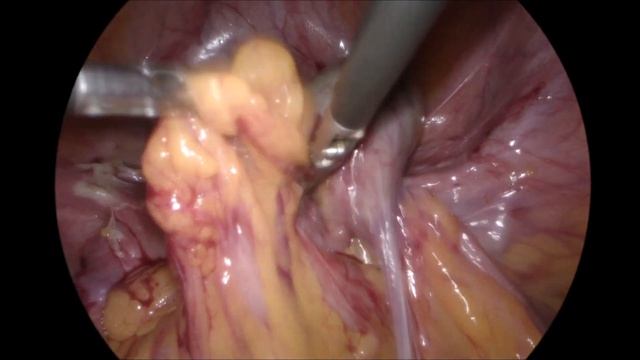 LAPAROSCOPIC MANAGEMENT OF A HYDROSALPINX WITH CHRONIC TORSION смотреть онлайн
