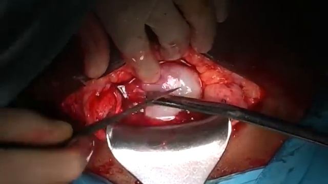 Caesarean section evidence-based surgical technique смотреть онлайн