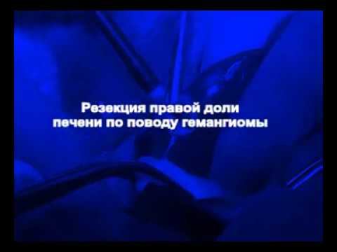 Резекция правои доли печени по поводу гемангиомы с использованием аргоноплазменнои коагуляции
