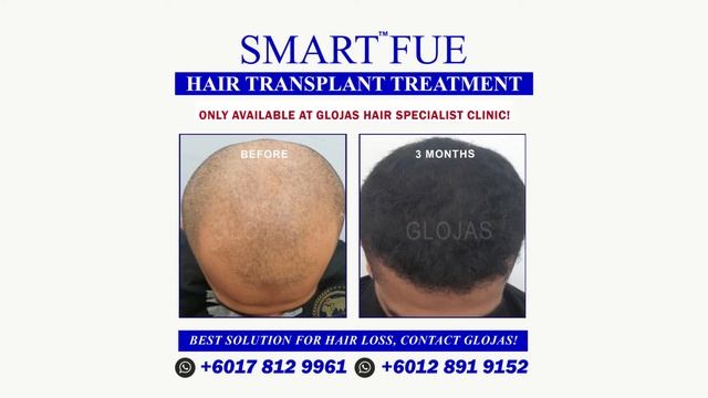 SMART™ FUE - Before & After [ 3 Months Result ] Hair Transplant Malaysia Specialist смотреть онлайн