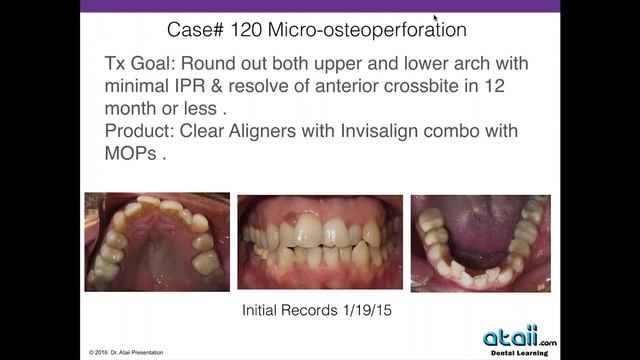 Dental Treatment: Accelerated Orthodontics May 10, 2016 смотреть онлайн