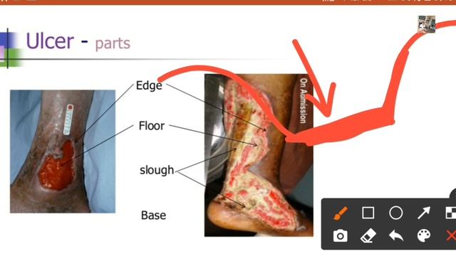 Ulcers- General Surgery Lecture| Classification,Etiology,Treatment, Complications!BDS/MBBS Lecture смотреть онлайн