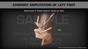 Ампутация левой стопы по Шопару