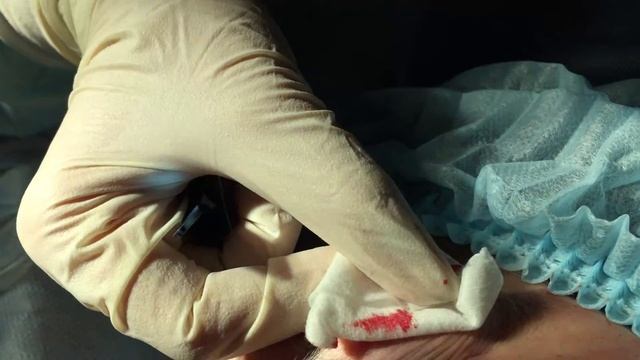 Как накладывать косметический шов на кожу смотреть онлайн