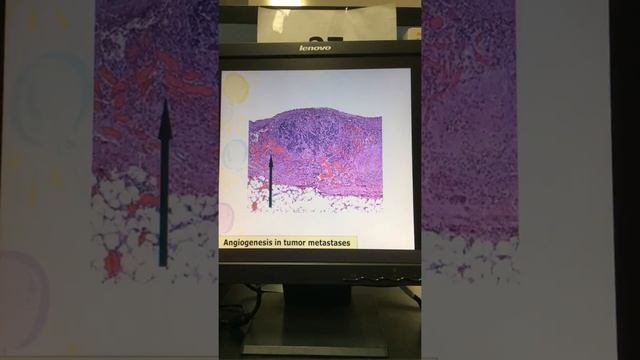 Pathology Lab #08: Neoplasia III cases