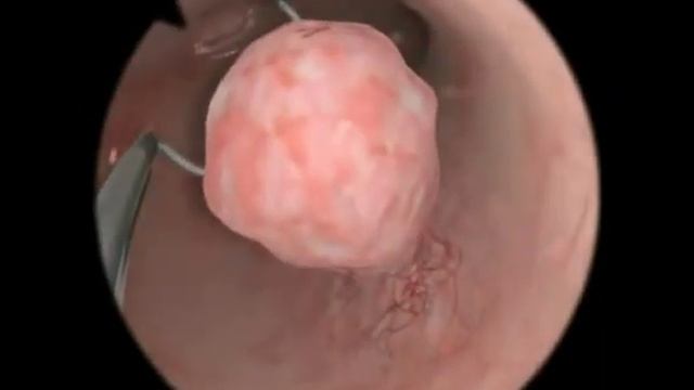 Hysteroscopic Polypectomy смотреть онлайн