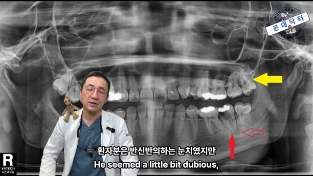 어금니 뽑고 임플란트 하러 온 환자 설득해서 임플란트 대신 사랑니 자가치아이식을 한 치과의사 #임플란트 #사랑니 #사랑니발치  wisdom tooth transplant