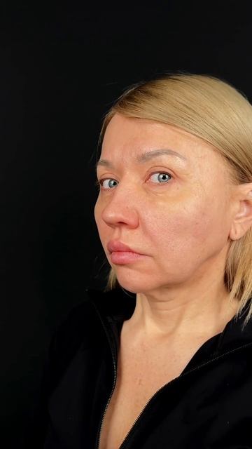 Чик-лифтинг и расширенная платизмопластика - как убрать второй подбородок и омолодить шею?
