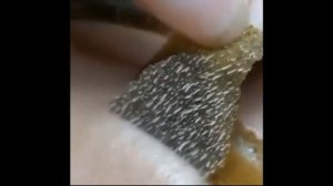 Выдавливание Чёрных Точек и Угрей на носу ! ЧИСТКА ЛИЦА Прыщи Nose Blackheads Squeezing