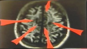 Опухоль, метастазы или артефакты?
#ГерманскаяНоваяМедицина #Хамер #Пилхар #ГНМ #Германише