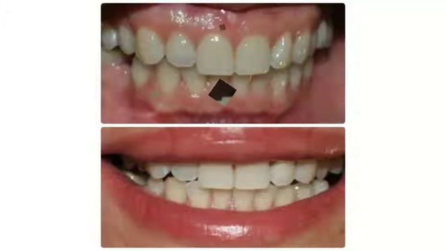 До и после. Отбеливание зубов Smile ROOM на Либкнехта 34 а