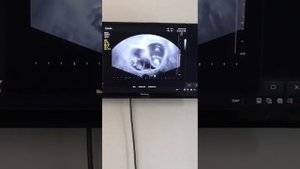 УЗИ ЭКО двойни//Сердцебиение