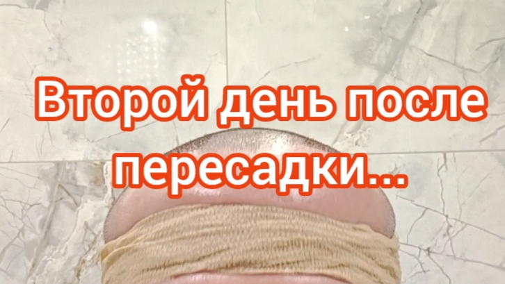 Пересадка волос. Второй день после пересадки.)