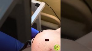 Гирудотерапия при грыже позвоночника