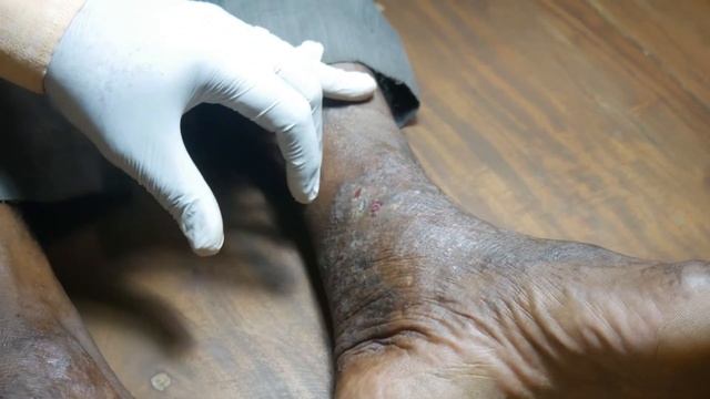 Chronic Eczema| நாட்பட்ட கரப்பான் நோய் | Infection | Fever with Skin Disease | Dr. Selvin | Tamil смотреть онлайн