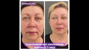 Эндоскопическое омоложение лица. «Бесшовная» технология хирургии.