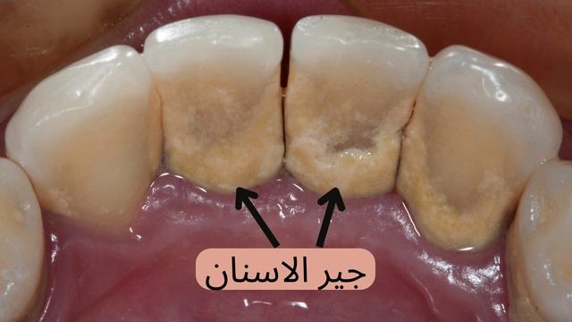 خراج الاسنان /اسباب خراج الاسنان /علاج خراج الاسنان смотреть онлайн