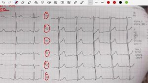 ЭКГ№1. Легко и просто. Лента ЭКГ.