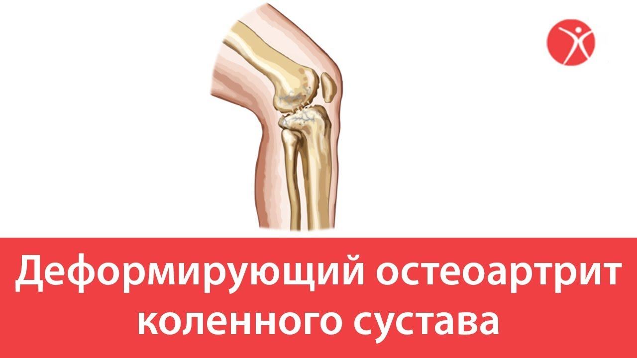 Деформирующий остеоартрит коленного сустава