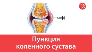 Пункция коленного сустава