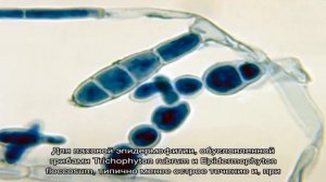 Паховая эпидермофития