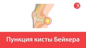 Пункция кисты Бейкера в клинике Стопартроз