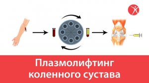 Плазмолифтинг коленного сустава в клинике Стопартроз