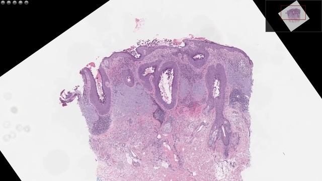 LE PEMPHIGUS FOLIACE - PATHOLOGIE смотреть онлайн