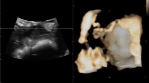 4 D узи беременность