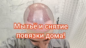 Как самому помыть голову после пересадки волос? Снятие повязки с донорской зоны.
