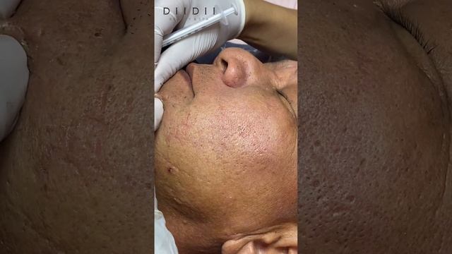 Blackhead removal woww..