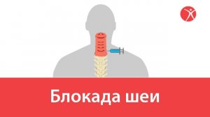 Блокада шеи в клинике Стопартроз