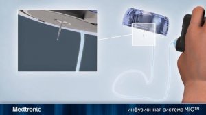 Инфузионный набор Mio