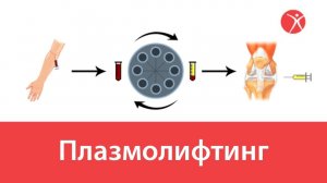 Плазмолифтинг в ортопедии